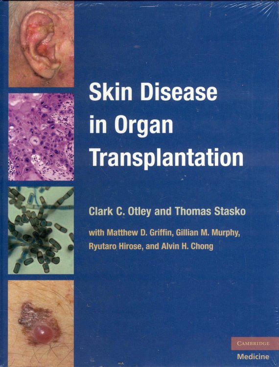 Skin Disease in Organ Transplantation